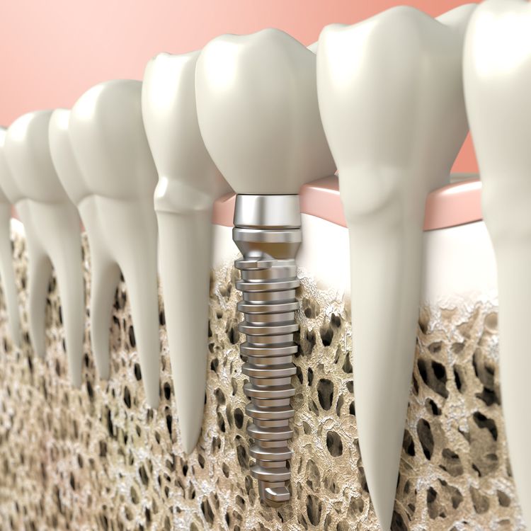 Tips To Avoid Dental Implant Failure