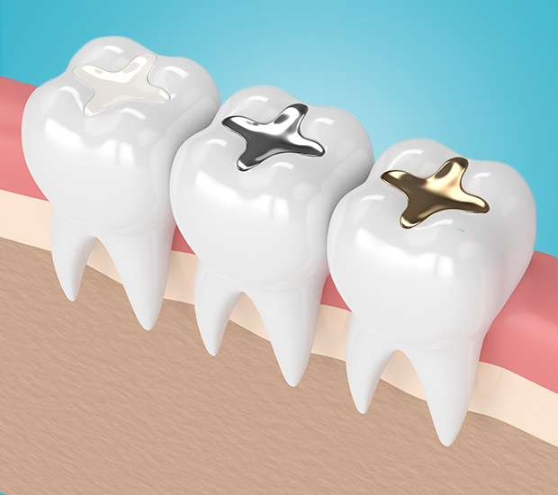 Brookfield Composite Fillings