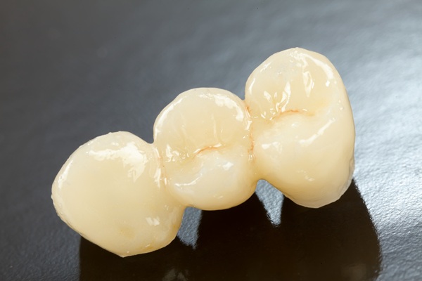 Why Dental Bridges Are An Effective Tooth Restoration