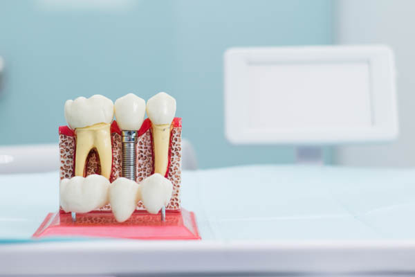 Three Benefits Of Dental Implants