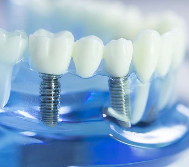 Brookfield Dental Implants