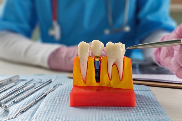 Am I A Candidate For Implant Restoration?