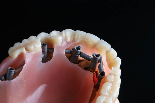 Implant Supported Dentures Brookfield, WI