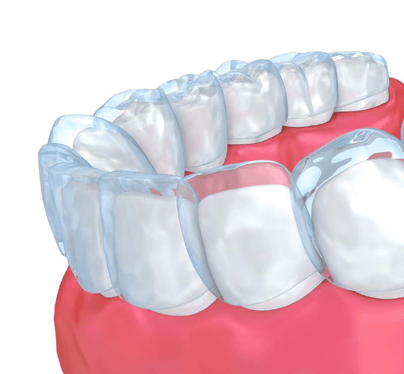 How To Clean Invisalign Aligners