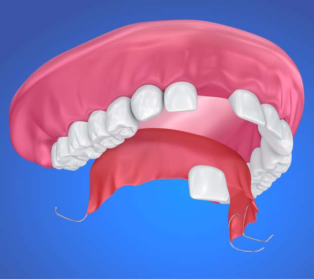 Brookfield Partial Denture for One Missing Tooth