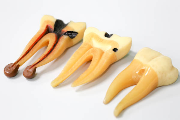 Root Canal Therapy From A General Dentist For A Cracked Tooth