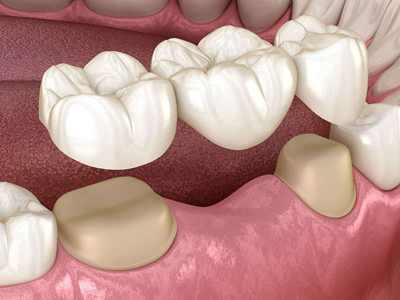 Dental Bridge Recovery And Aftercare