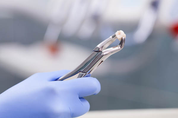 Tips For Tooth Extraction Aftercare