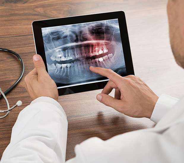 Brookfield Types of Dental Root Fractures