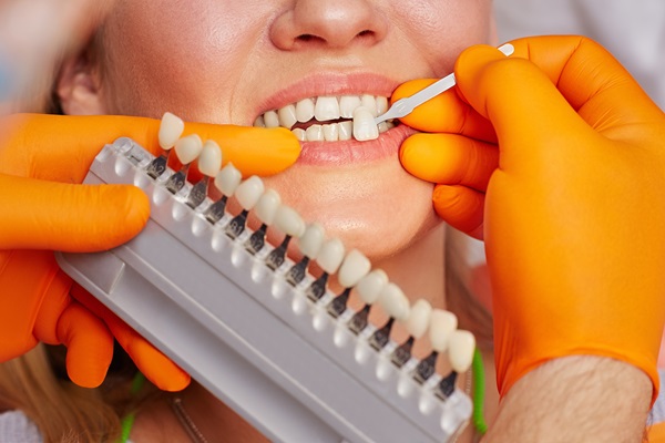 Ways To Prepare For Dental Veneers